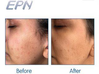 Visible Reduction in Acne Scars