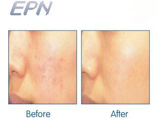 Dramatic Fading of Acne Scars